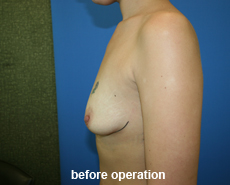 plastic-surgery-breast-augmentation